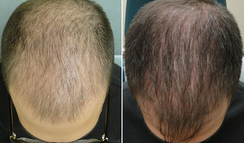 Hair Loss Treatment – Dallas Dermatology and Aesthetics
