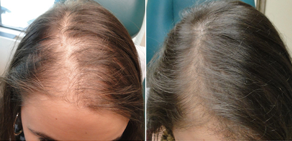 Hair Loss Solutions Dallas